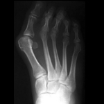 Hallux Valgus